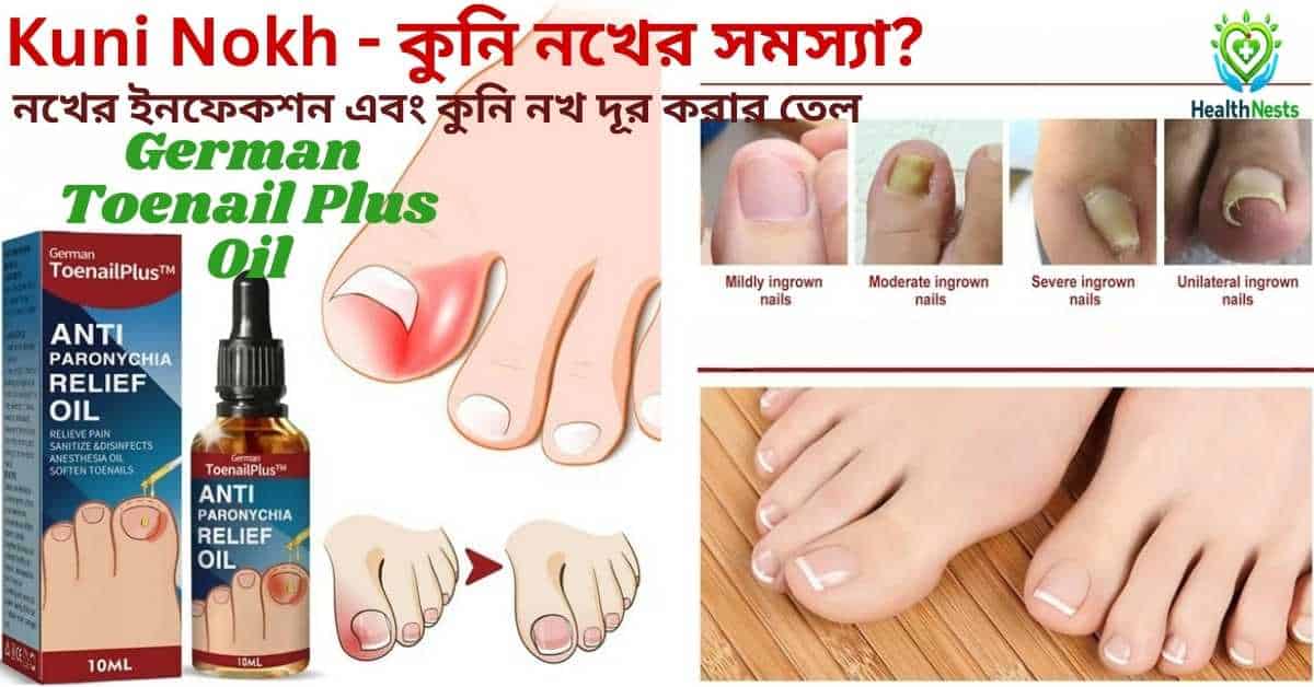 Kuni-Nokh-কুনি-নখের-সমস্যা-Kuni-Nokh-এর-জন্য-সেরা-ও-কার্যকরী-তেল-এবং-সমাধান
